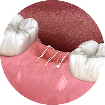 Mucogingival-Surgery