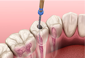 What Are the Phases of Dental Implant Procedure?