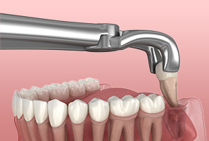 Say Goodbye to Discomfort: Wisdom Tooth Problems & Solutions