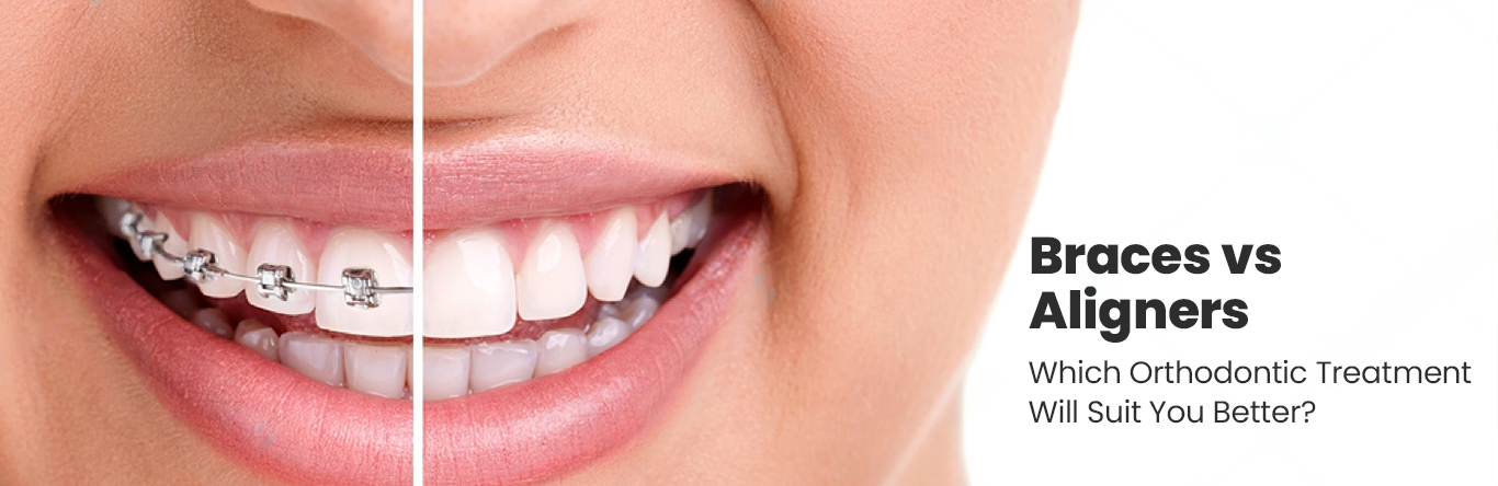 Braces vs Aligners – Which Orthodontic Treatment Will Suit You