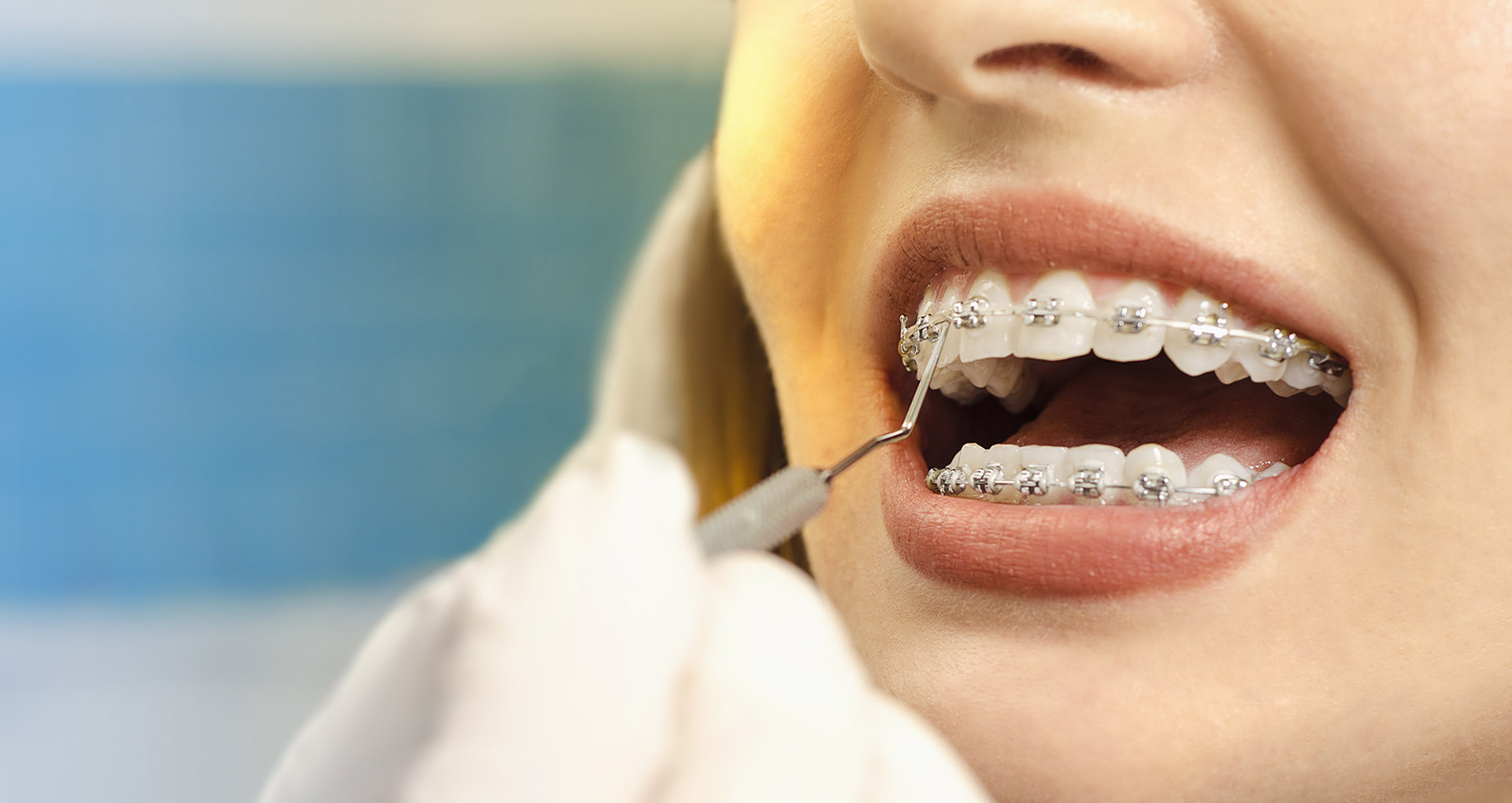 How to Take Care of Your Braces