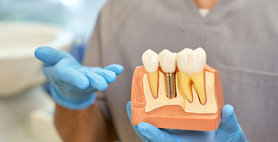Are Dental Implants Right for You? Expert Guide