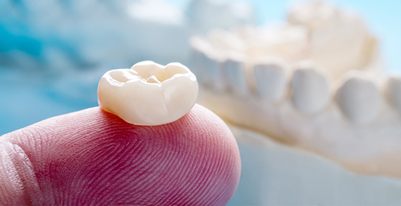 Unveiling The Vital Role Of Dental Crowns In Restoring Smiles