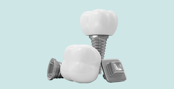 Dental Implants: All on Four, Single Tooth, Full Mouth