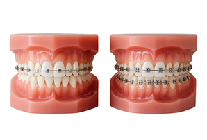 Self-Ligating Braces vs Traditional Braces – Know the Difference