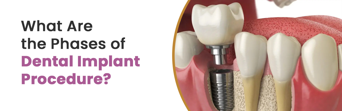 What Are the Phases of Dental Implant Procedure?