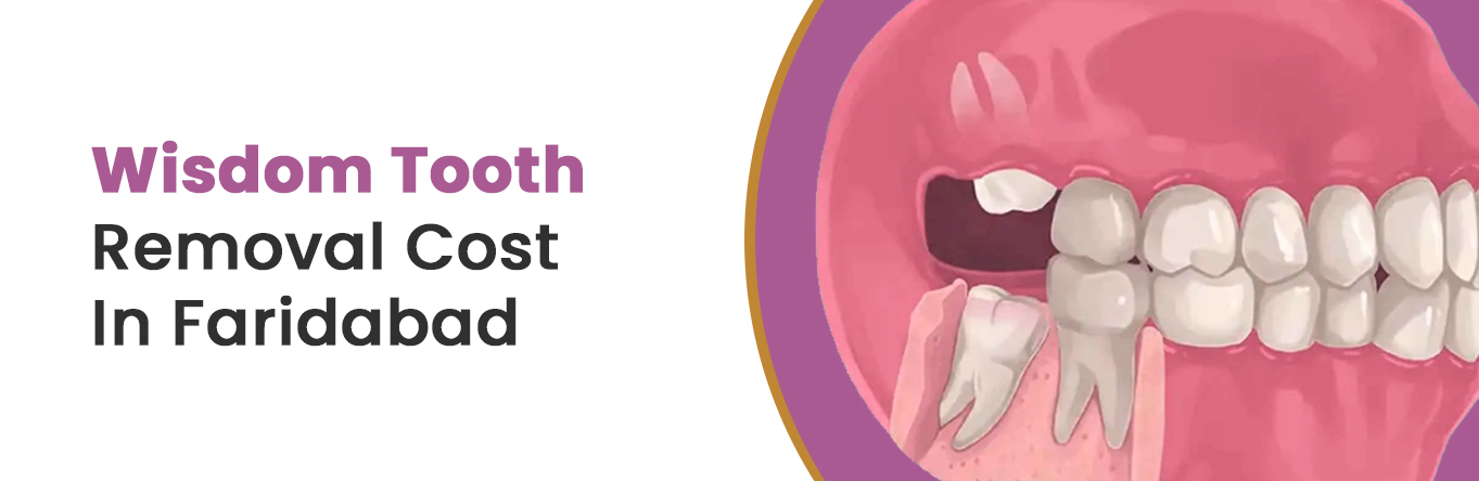 Wisdom Tooth Removal Cost In Faridabad