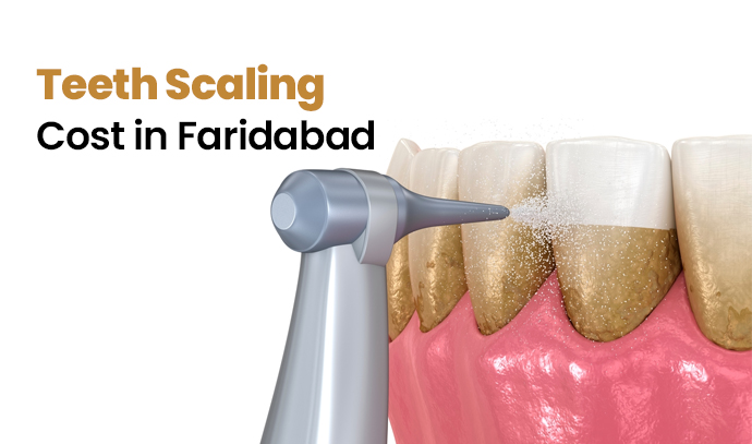 Teeth Scaling Cost in Faridabad