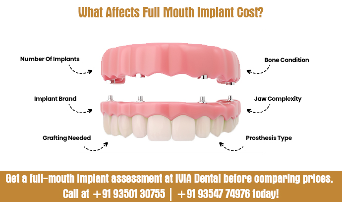 what affects full mouth implant cost