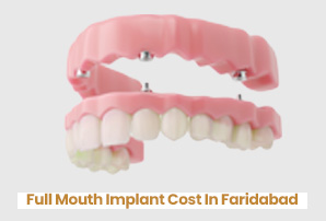 Full Mouth Implant Cost In Faridabad