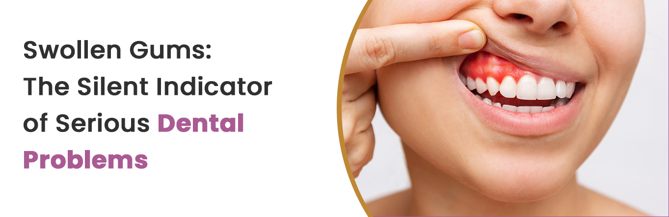 Swollen Gums: The Silent Indicator of Serious Dental Problems