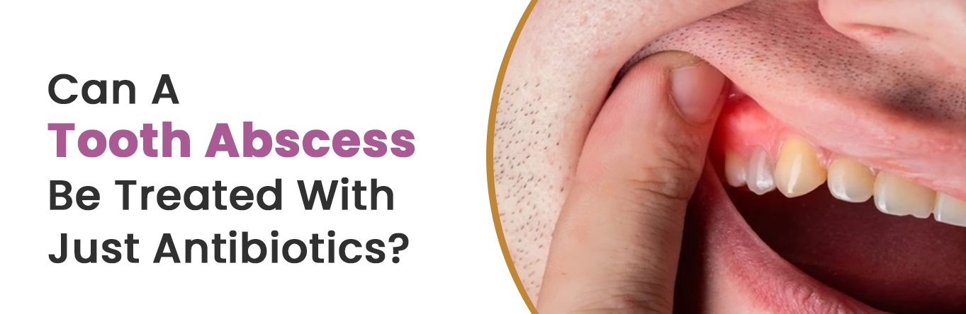 Can A Tooth Abscess Be Treated With Just Antibiotics?