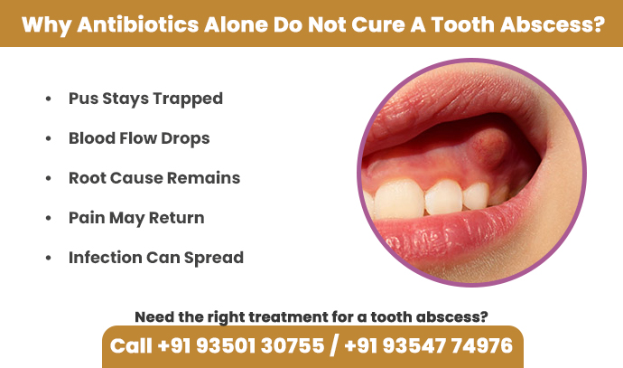 why antibiotics alone do not cure tooth abscess