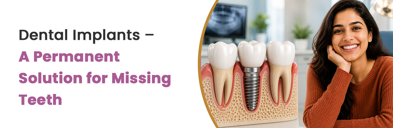 Dental Implants – A Permanent Solution for Missing Teeth